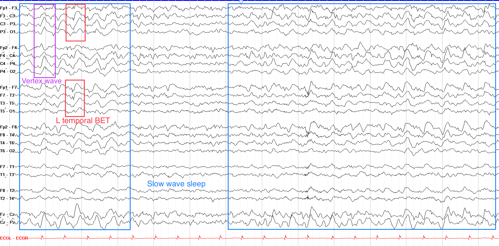 The Normal Asleep EEG